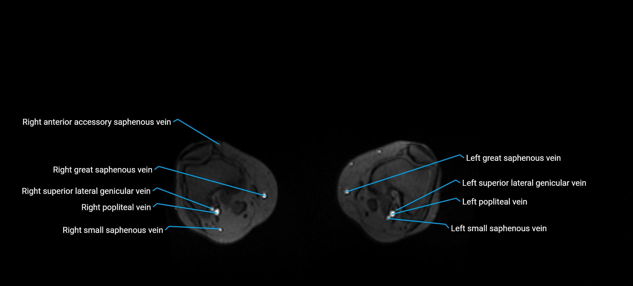 MRV abdomen pelvis & lower limb axial cross sectional anatomy labelled MRI image 359.webp